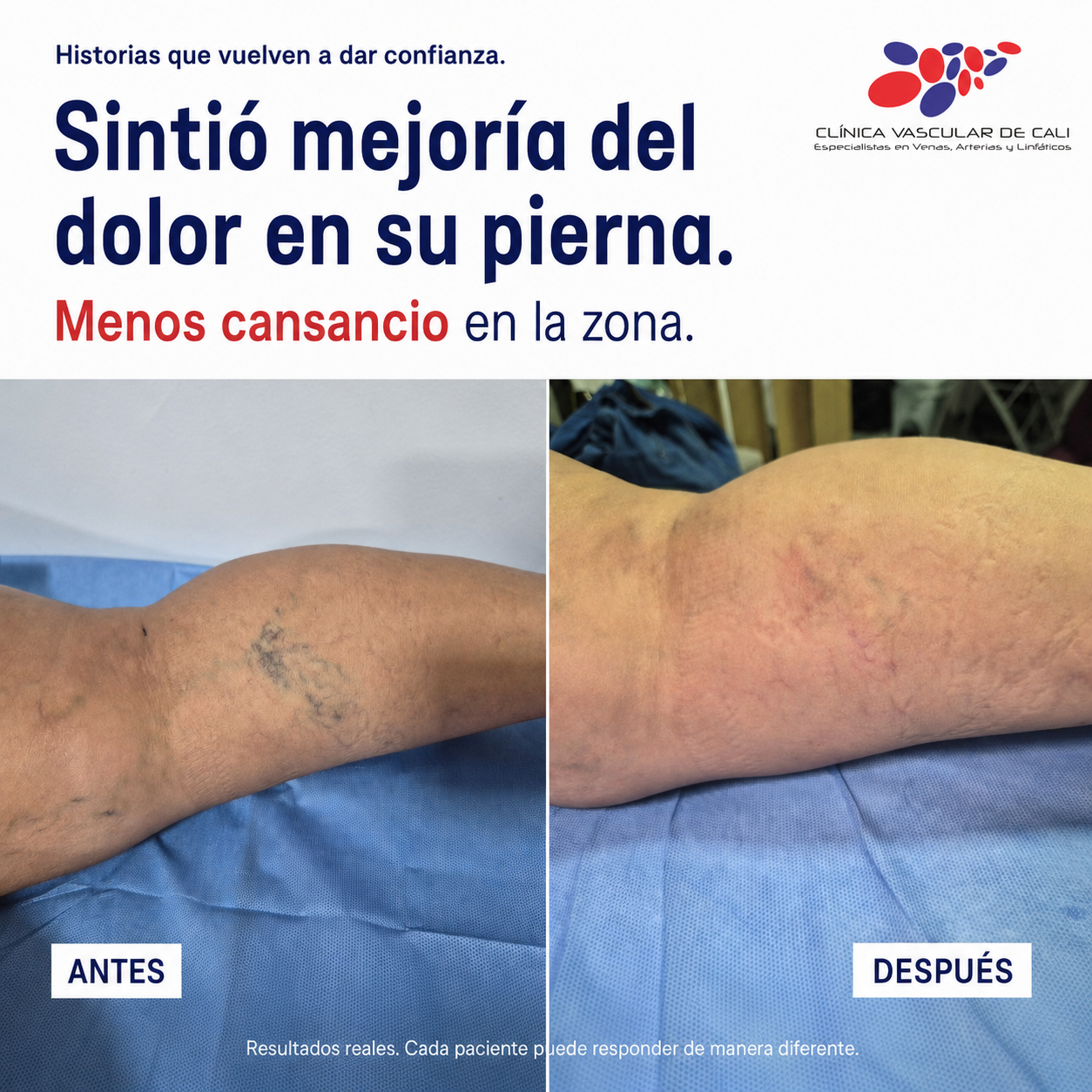 Caso real de escleroterapia con mejoría del dolor en pierna.
