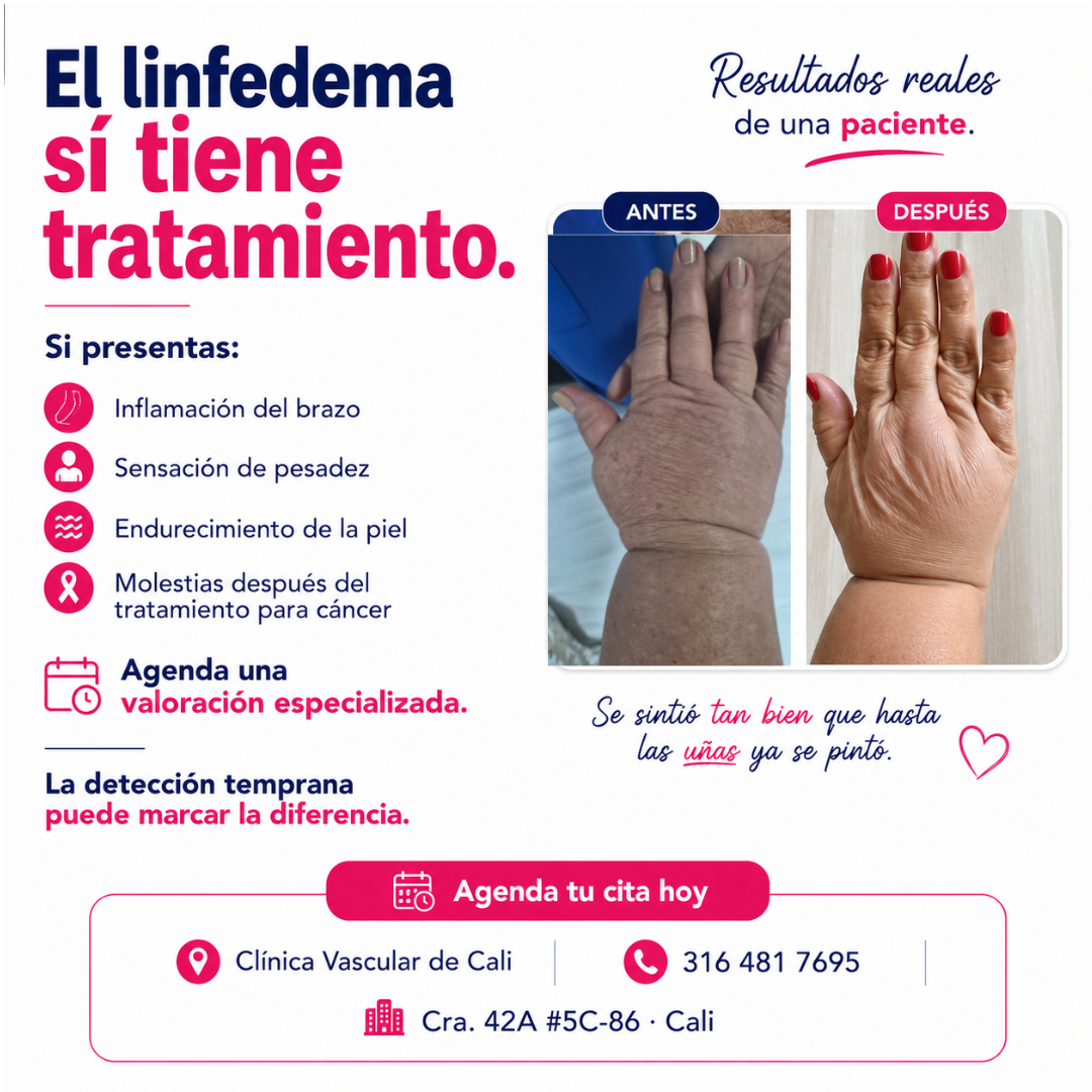 Caso real de linfedema con antes y después de tratamiento.